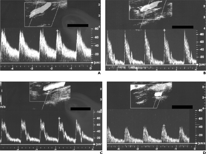 Analyzing an ecg tracing ica