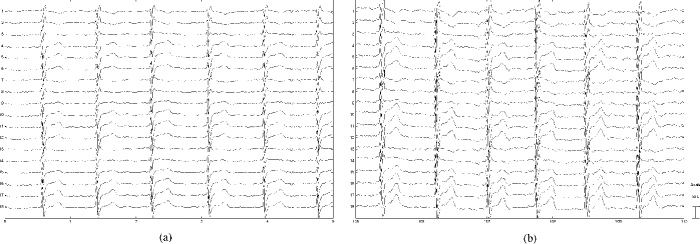 Analyzing an ecg tracing ica