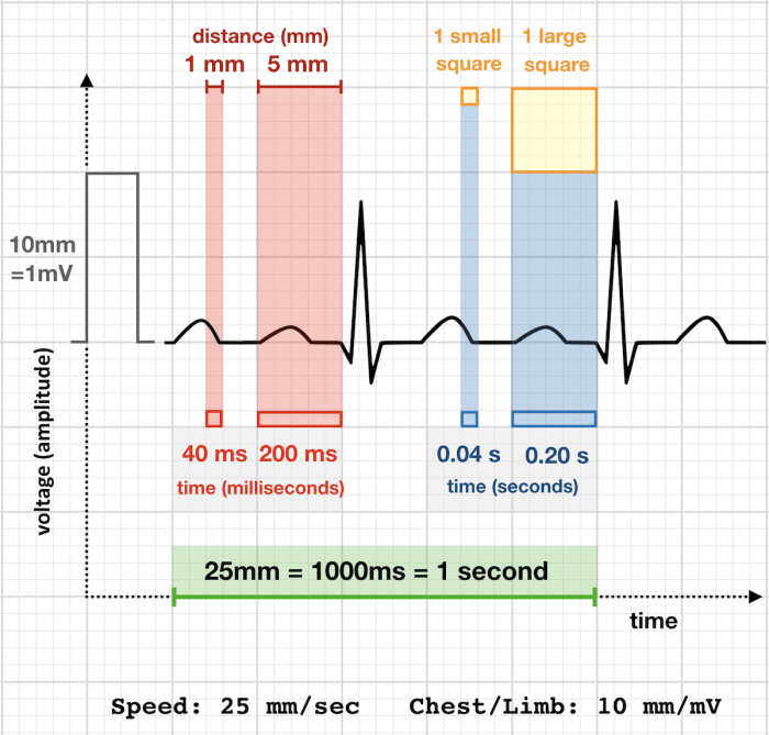 Analyzing an ecg tracing ica