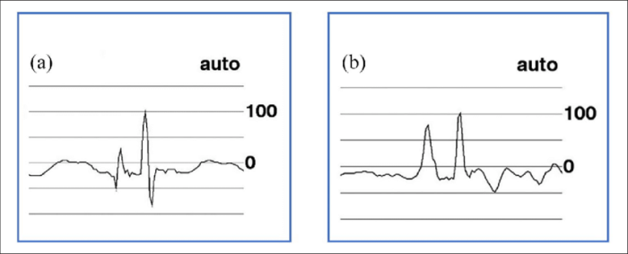 Analyzing an ecg tracing ica