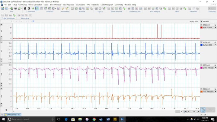 Analyzing an ecg tracing ica